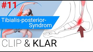 TibialisposteriorSyndrom erklärt  Sehnenschädigung am FussInnenknöchel [upl. by Kristo104]